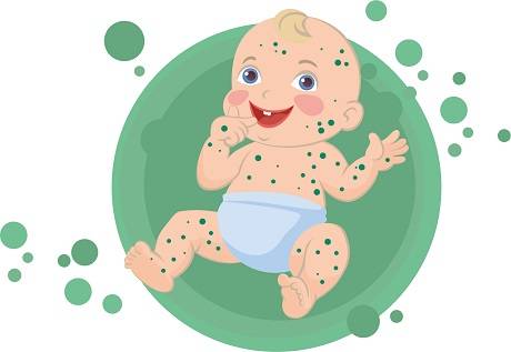 ветрянка ветрянка