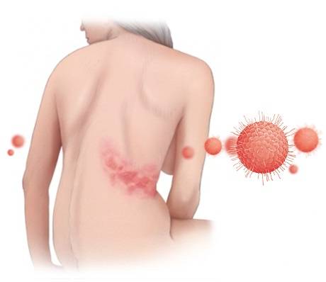 ветрянка ветрянка