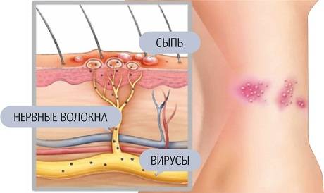 ветрянка ветрянка