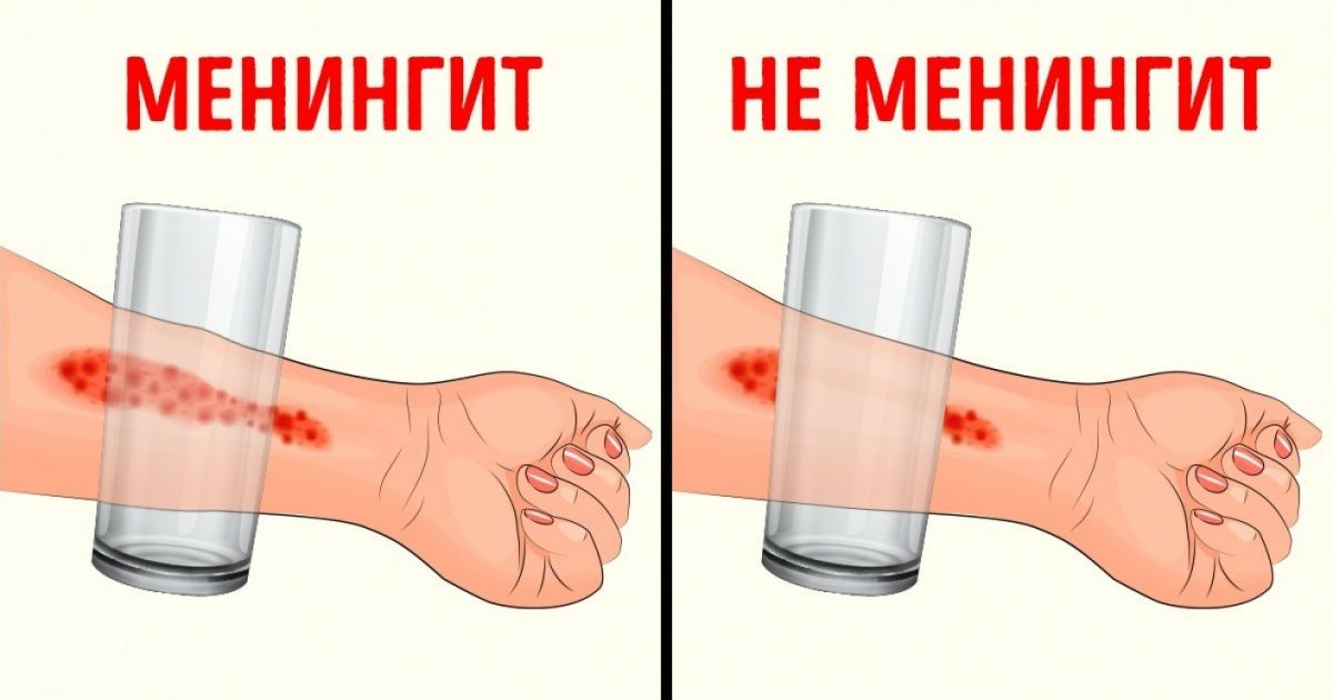 тест на менингококковую сыпь.jpg тест на менингококковую сыпь.jpg