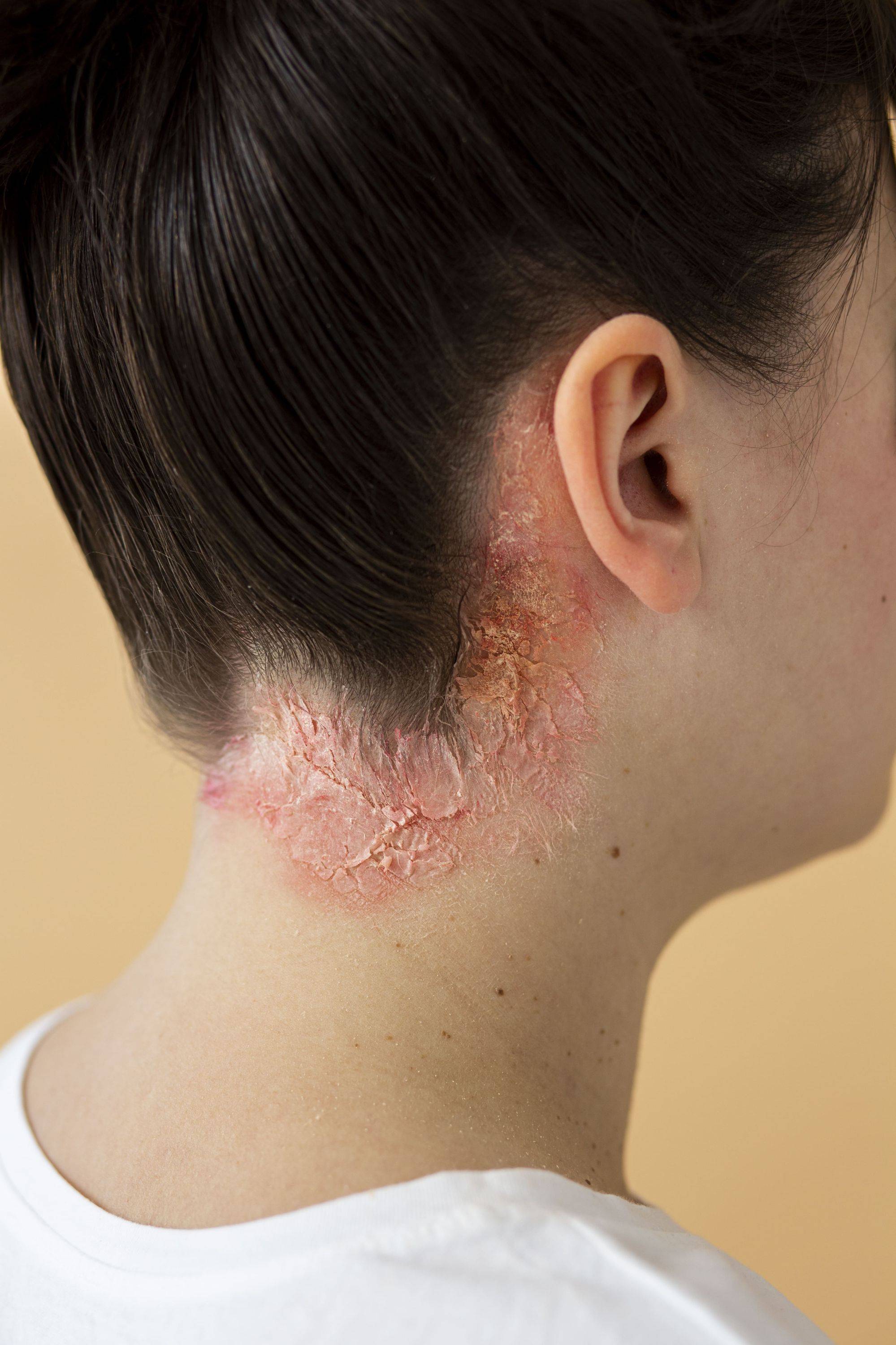 ppsoriasis-eczema-on-neck-of-patient.jpg